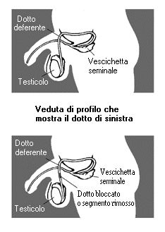 immagine vasectomia
